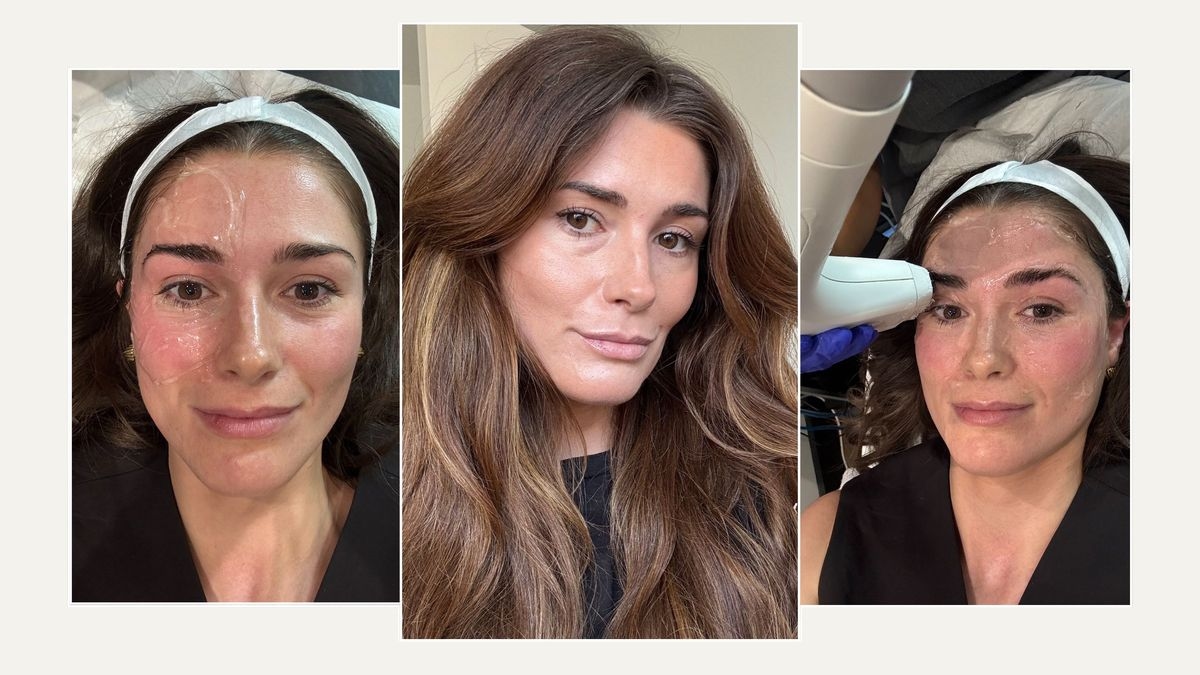 I Tried This Lifting and Sculpting Treatment As a Botox Alternative–These Are My Receipts After 3 Months
