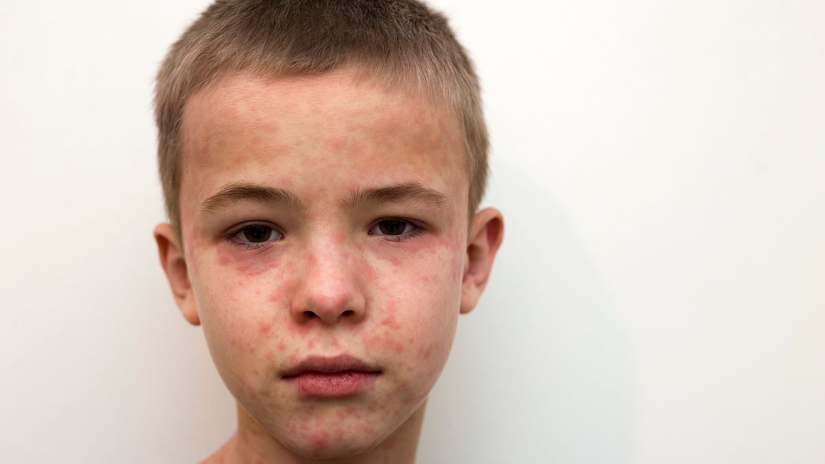 Multi-state outbreak fears as measles hits popular tourist attraction with untold number infected