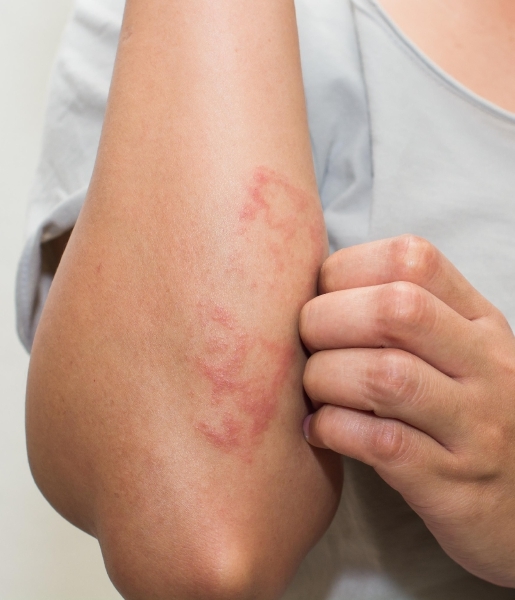 KI ermöglicht genauere Dermatitis-Diagnosen