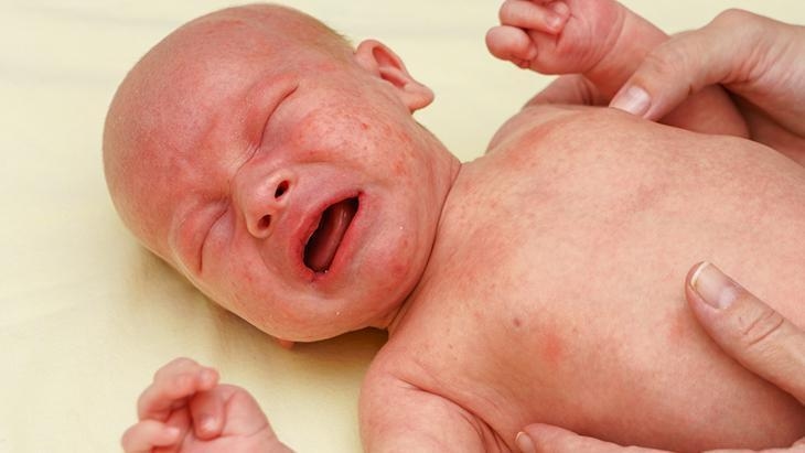 Die Übertragung erfolgt durch Niesen und Husten! Es ist wichtig, sofort mit der Behandlung zu beginnen