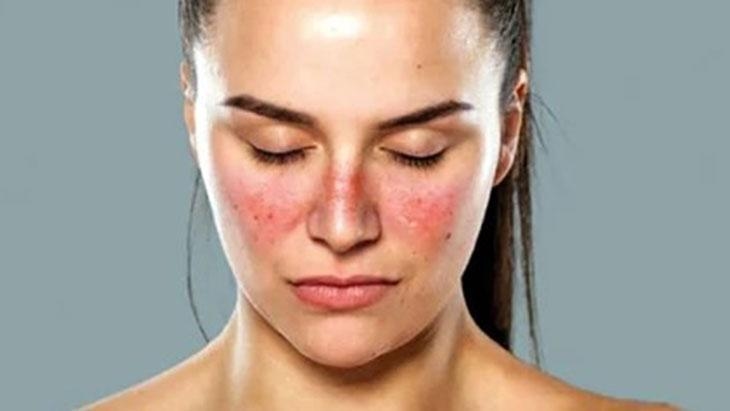 Spots on your face may be a sign of lupus! It can affect many organs