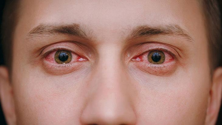 ¡No ignore los riesgos en los meses de verano! Puede causar pérdida permanente de la visión.