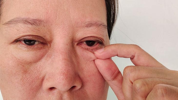 Causa enrojecimiento y ardor en los ojos. Puede causar pérdida de visión.