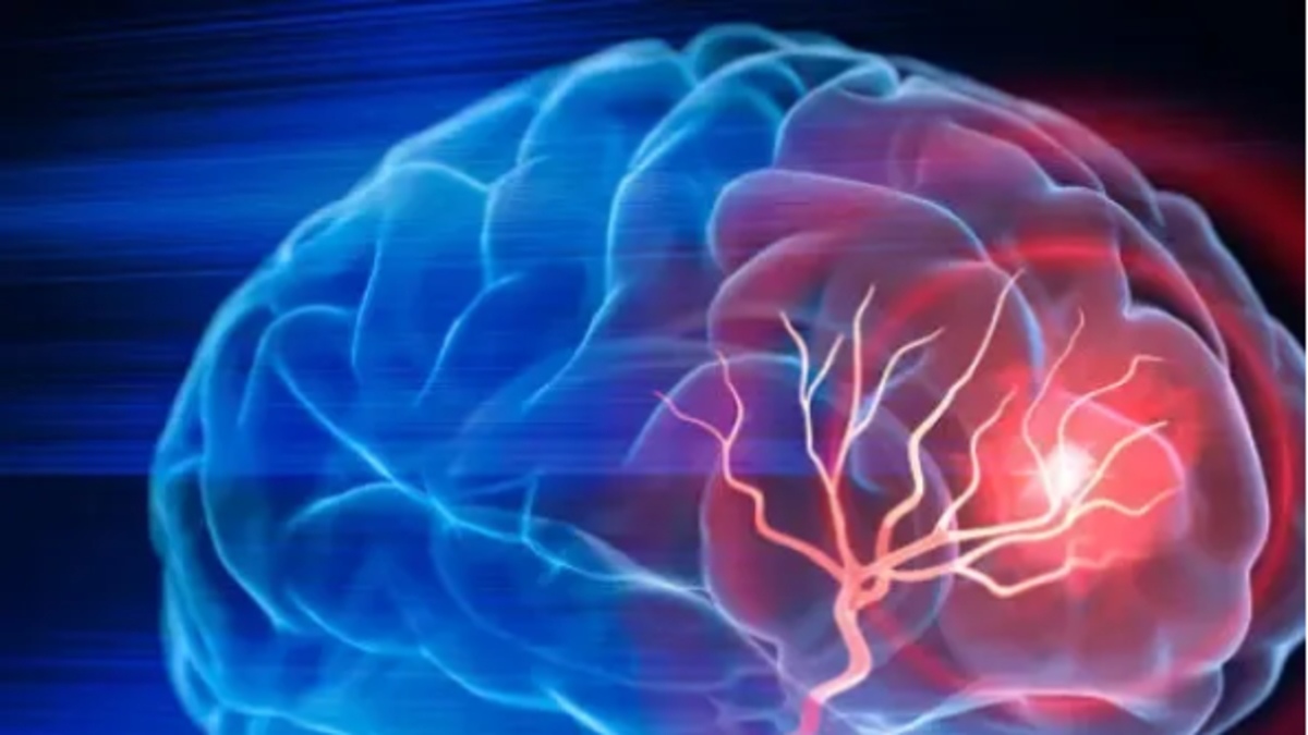 Schlaganfall: Dies sind die Symptome der zweithäufigsten Todesursache und der häufigsten Ursache für Behinderungen in Kolumbien.