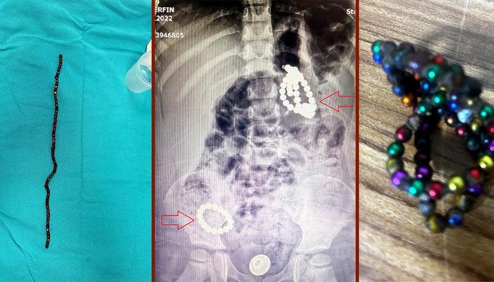 This toy is a death trap! Shocking case: A 3-year-old lived for months with 66 magnets in her belly! Warning: "It punctures her internal organs."