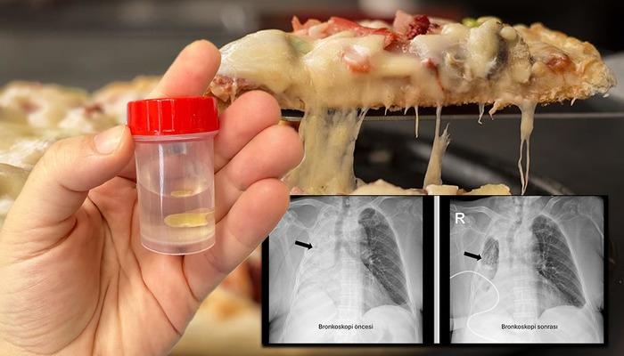 La comida que ingirió casi le cuesta la vida: ¡Su pulmón derecho colapsó por completo! Cinco meses después, se descubrió que tenía la tráquea obstruida...