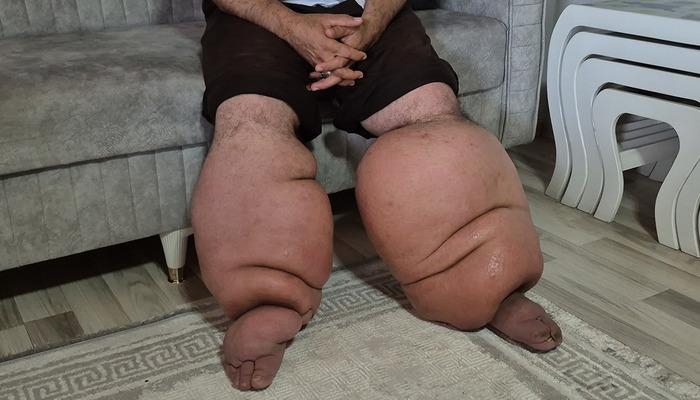 Hace 15 años, su vida cambió irreversiblemente: ingresó en el hospital con fiebre alta y no pudo caminar...