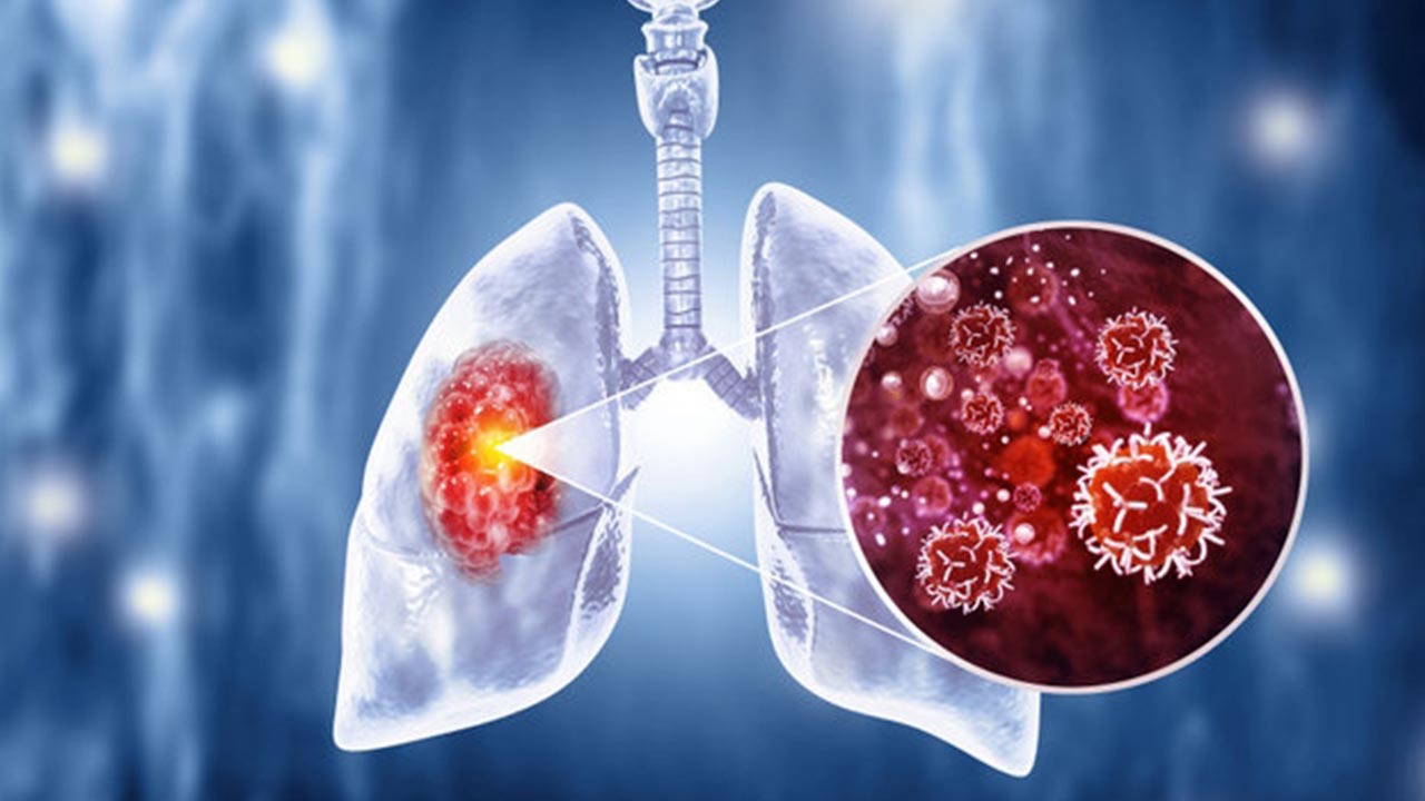 Un expert met en garde : « La nutrition influence l’immunité dans le cancer du poumon »