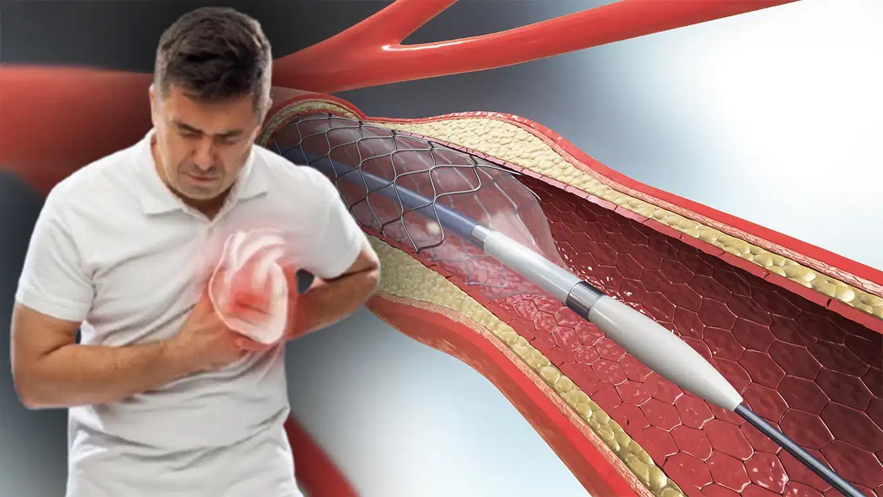 Experten warnen: Angst vor Stents kann Leben kosten!