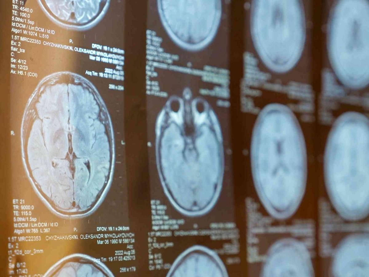 Multiple sclerose: waarom keert ons immuunsysteem zich tegen ons?