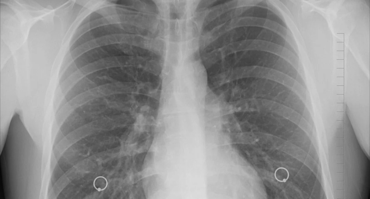 Radioterapia asistida por algoritmos: la IA mejora la precisión del tratamiento del cáncer de pulmón