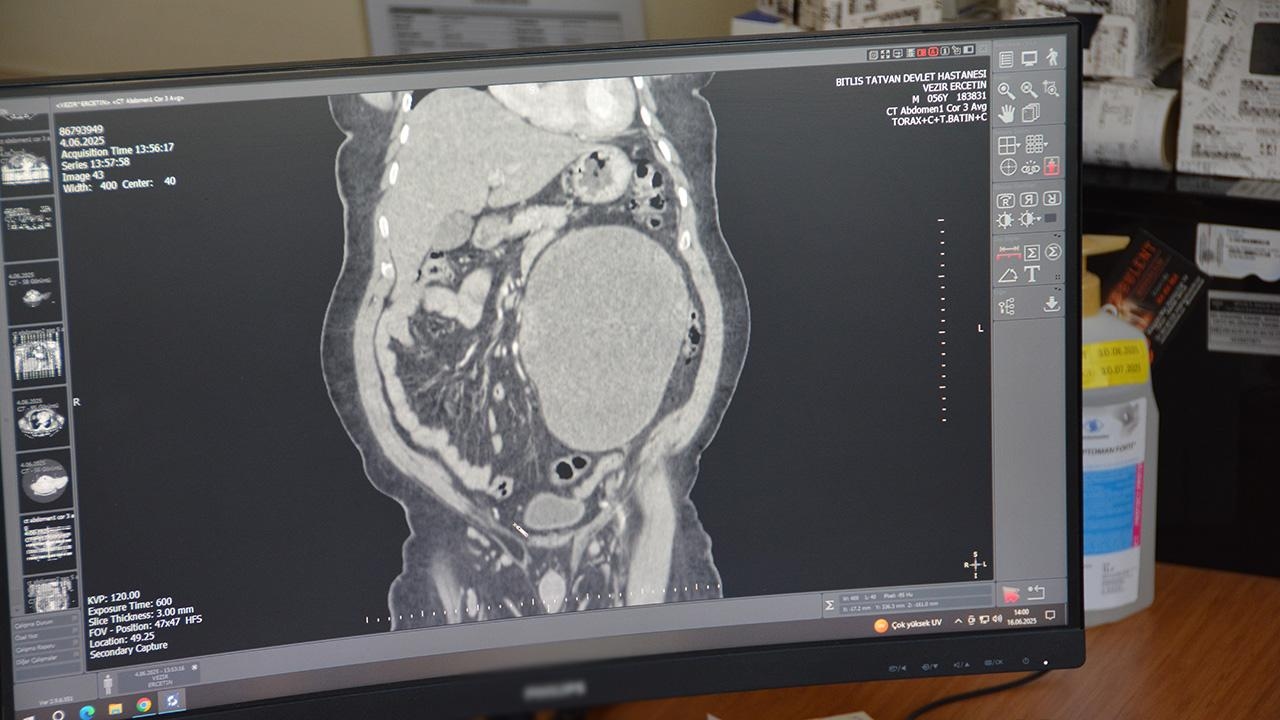 Er kam mit der Beschwerde über Bauchschmerzen und in seiner Niere wurde eine 23 cm große Zyste gefunden.