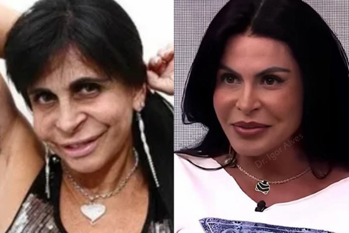 Blepharoplasty: when to invest in the procedure performed by Gretchen