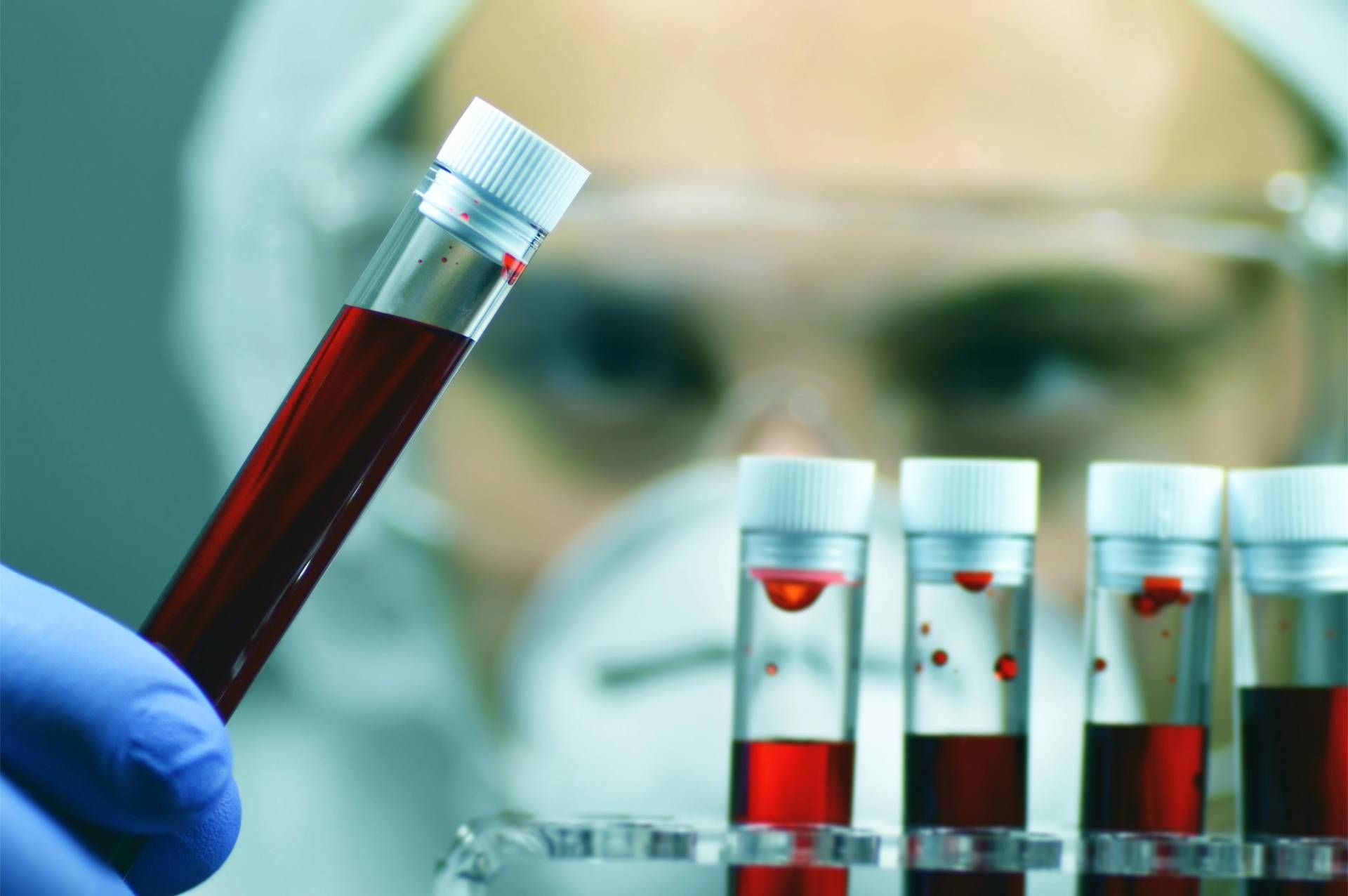 Alzheimer: Exame de sangue em estudo para auxiliar diagnóstico precoce
