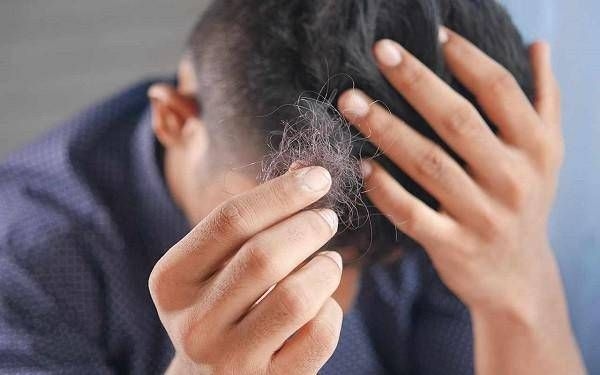 Il dermatologo: "Con alopecia areata disagi e costi alti, svecchiare linee guida"