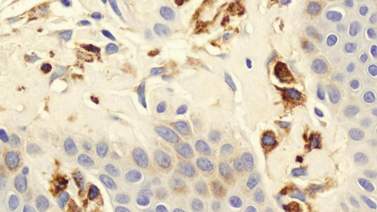 Mastocytose : comment reconnaître les symptômes et traiter cette maladie rare