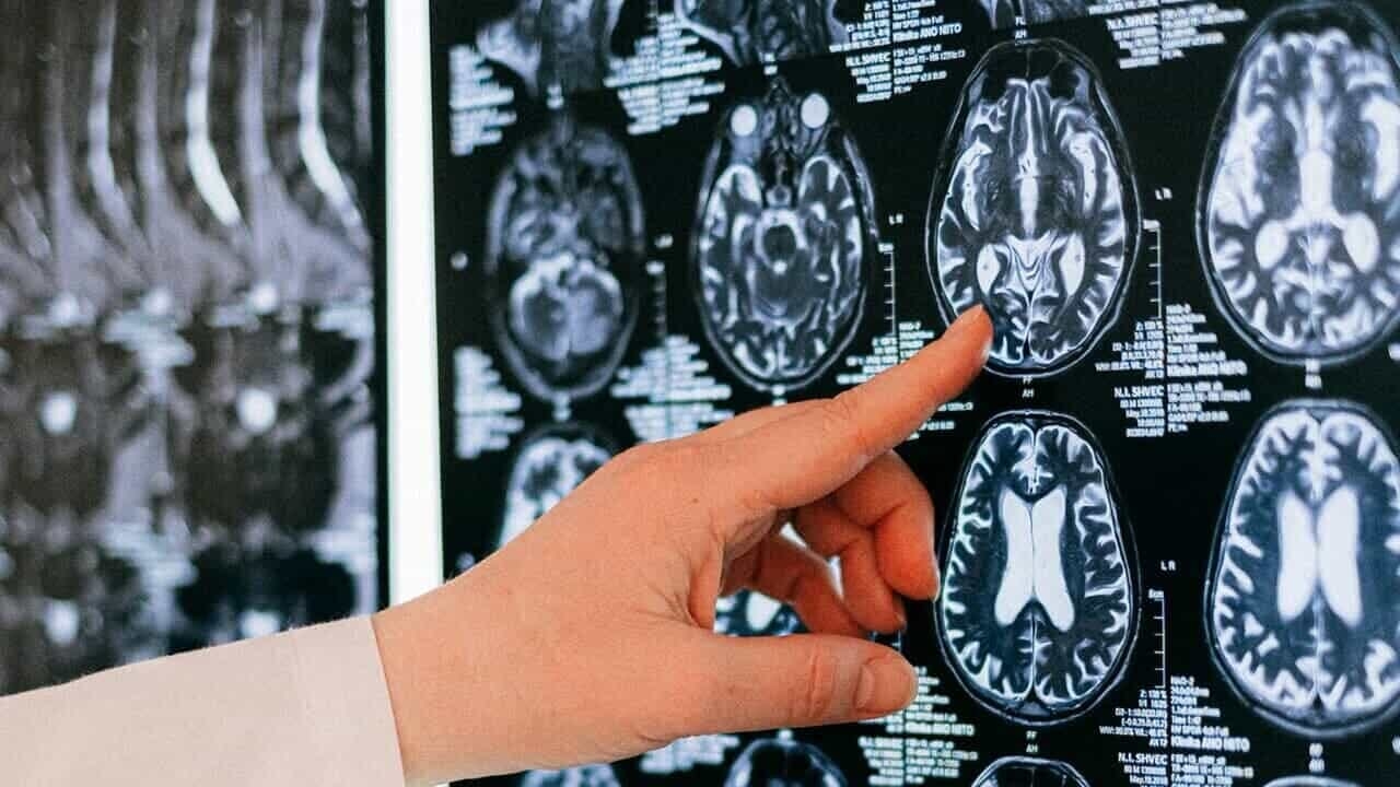 Alzheimer's is diagnosed with a blood test
