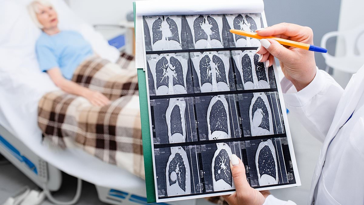 'Eu sentia dores insuportáveis... o médico disse que era apenas o desconforto da amamentação': Gini não fumava e uma forte dor no ombro a deixava em agonia. Eventualmente, ela descobriu que era câncer de pulmão. Agora, nossa especialista revela os sina...