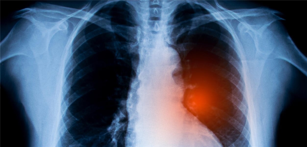 Carcinoma polmonare non a piccole cellule: i vaccini contro il cancro potrebbero aumentare i tassi di sopravvivenza