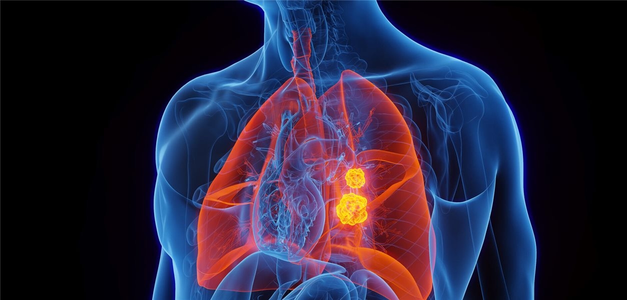 NSCLC con mutazione EGFR: cosa è importante per la diagnosi e la terapia